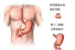 消化道出血会疼吗,消化道出血疼痛症状解析